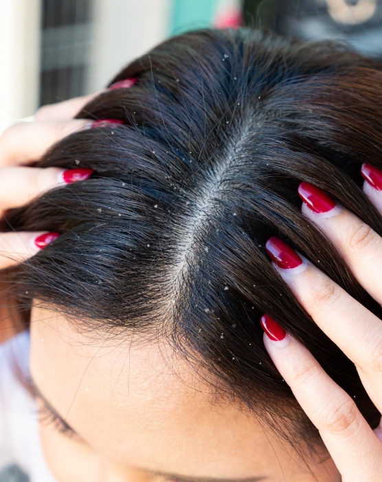 Capelli Splendidi Anche d'Inverno: Soluzioni per Combattere la Secchezza e la Forfora